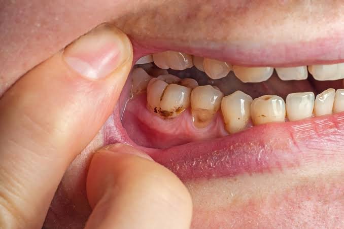 how to prevent cavities