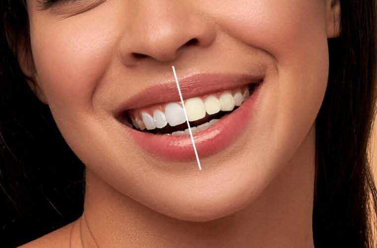 yellow teeth home remedies