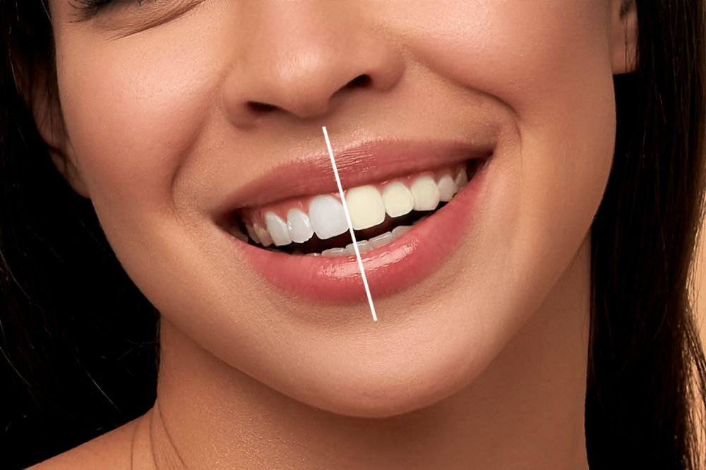 yellow teeth home remedies